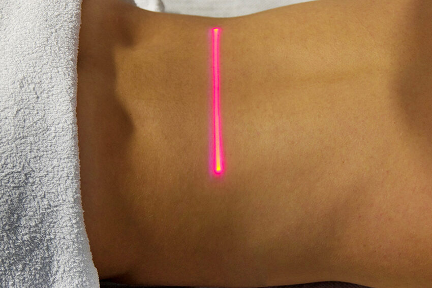 Laserterapia